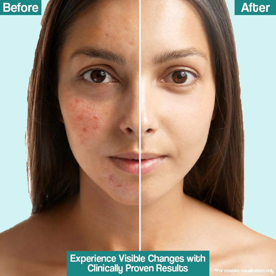 Venusia Acne Lotion 75gm - Image 5